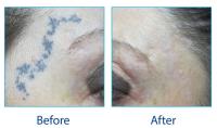 Laser Tattoo Removal Leicester image 6
